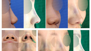 bulbous nose + upturned nose + columella lengthening(closed rhinoplasty)