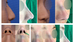hump nose + bulbous nose + hanging nose + columella lengthening(closed rhinoplasty)