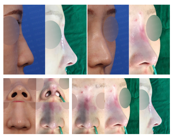 Before and after revision rhinoplasty for long nose and hanging tip at Noselab Plastic Surgery