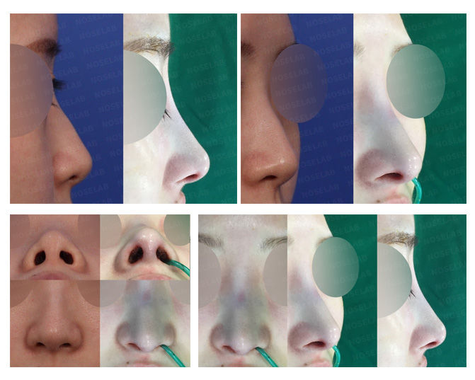 closed rhinoplasty + flat nose + small nose + upturned nose + hump nose