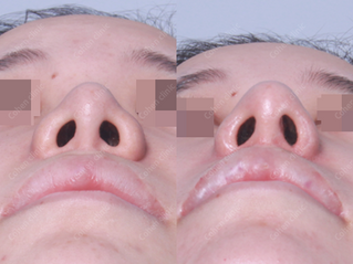 Closed rhinoplasty + revision + rib cartilage + osteotomy + angle correction + alar rim lift + alarplasty(outside)+ alar width reduction + bulbous nose correction + columella redesign
