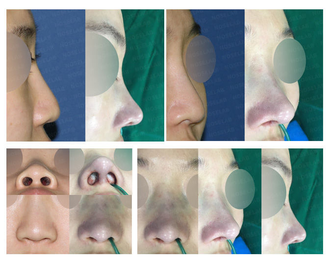 Before and after photo of Closed Rhinoplasty Korea correcting long, bulbous, and hanging nose tip through nasal length design.