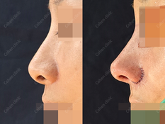 Closed rhinoplasty + revision + tip plasty(rib cartilage) + silicone + osteotomy + revision alar plasty(outside) + columella redesign + bulbous nose correction
