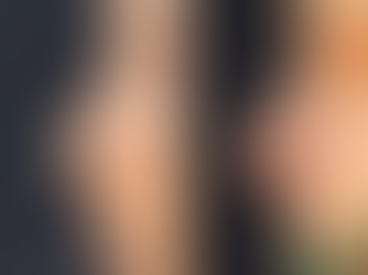 Closed rhinoplasty + revision + tip plasty(rib cartilage) + silicone + osteotomy + revision alar plasty(outside) + columella redesign + bulbous nose correction