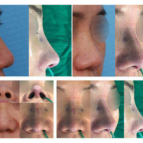Bulbous nose correction with columella lengthening and nostril asymmetry balancing before and after closed rhinoplasty