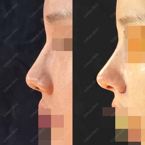 Closed rhinoplasty + rib cartilage + alloderm + bulbous nose correction + septoplasty + alarplasty + deviated nose correction + columella lenthening