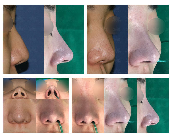 hump nose + correcting hanging nose tip + reshaping bulbous nose tip