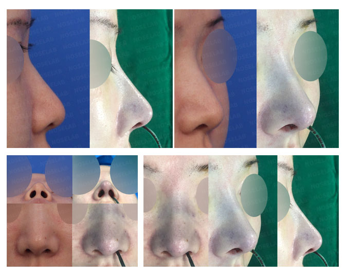 Closed Rhinoplasty Korea Before and After Long Nose Correction