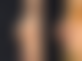 Closed rhinoplasty + Rib cartilage + alloderm + alar rim graft + alarplasty(outside) + osteotomy +bulbous nose correction 