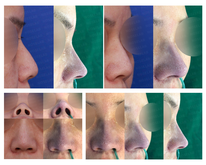 Hanging and Upturned Nose Correction – Noselab Plastic Surgery Before and after closed rhinoplasty for hanging columella and upturned nasal tip correction at Noselab Plastic Surgery