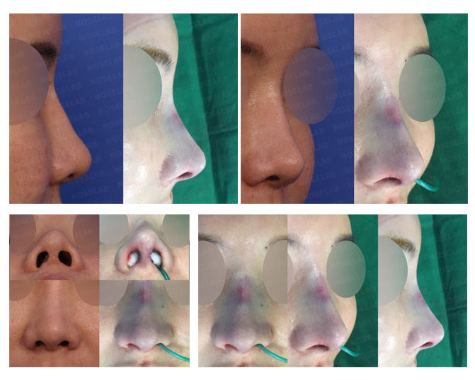 Before and after closed rhinoplasty in Seoul correcting deviated and flat nose by redesigning the nasal bridge and balancing nostril asymmetry — achieved natural symmetry without external incision.