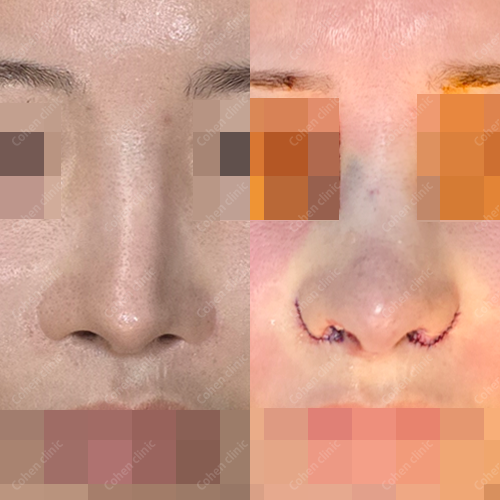 Closed rhinoplasty(revision) + rib cartilage + alloderm + osteotomy + alarplasty + alar base reconstruction + deviated nose correction + droopy nose correction + arrow nose correction