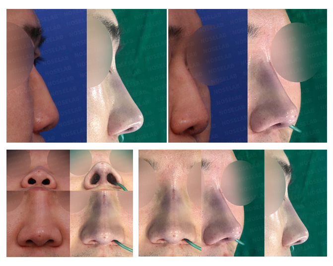 Before and after closed rhinoplasty for bulbous nose correction at Noselab Plastic Surgery, Seoul — performed by Dr. Chayoung Kang