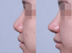Closed rhinoplasty + revision + rib cartilage + osteotomy + angle correction + alar rim lift + alarplasty(outside)+ alar width reduction + bulbous nose correction + columella redesign