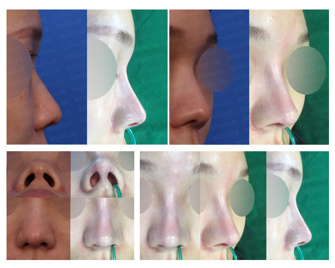 Before and after of Upturned Nose Correction Korea – closed rhinoplasty correcting upturned and hanging nose tip with depressed bridge improvement.