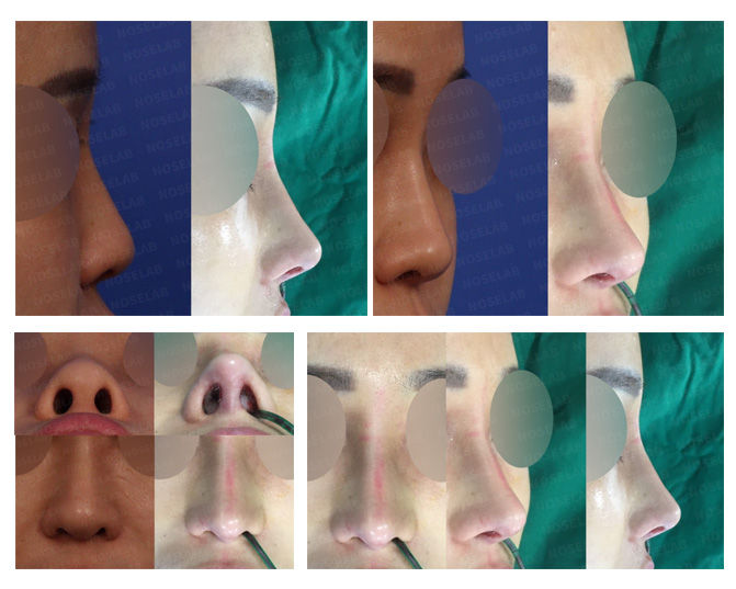 Before and after closed rhinoplasty showing bulbous nose correction by lowering the nasal starting point and refining the tip for a balanced nasal contour.