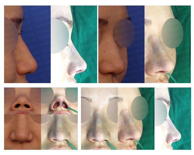 Side and frontal views before and after closed rhinoplasty Seoul for bulbous, hump, and droopy nose correction – showing refined nasal tip and improved columella balance.