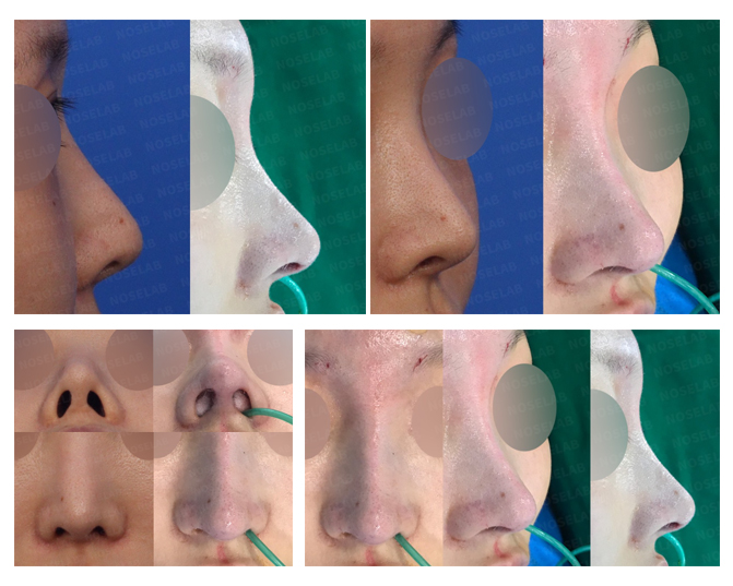 Revision Rhinoplasty Korea - Hanging and Upturned Nose Correction