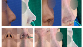 hanging nose + upturned nose + designing length + columella lengthening(revision rhinoplasty)