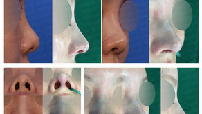 deviated nose + small nose + upturned nose + designing length + correcting nose tip + asymmetry