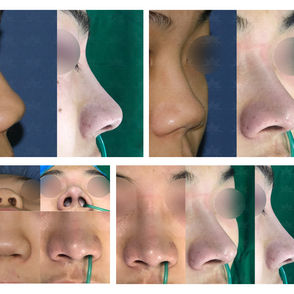 bulbous nose + columella lengthening(closed rhinoplasty)