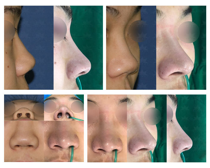 Photograph from the archive: bulbous nose , columella lengthening(closed rhinoplasty) (image 1)