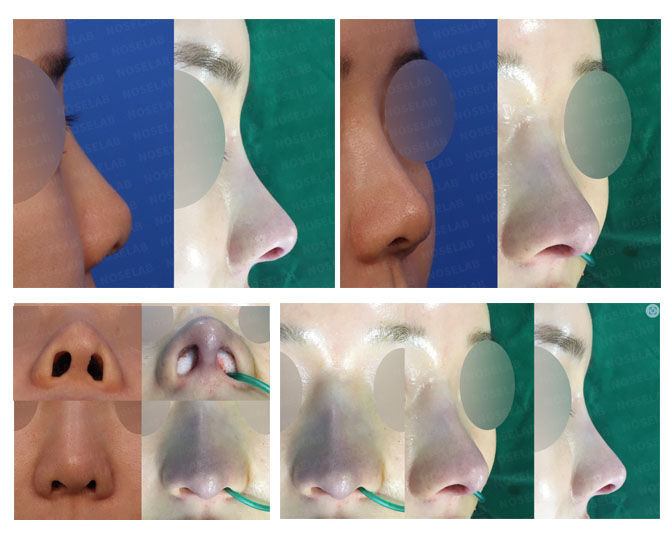 Before and after photo of Closed Rhinoplasty Korea correcting deviated and bulbous nose with columella design and nostril symmetry.