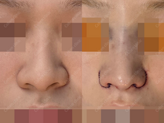 Closed rhinoplasty +  donated rib cartilage + silicone + alarplasty + bulbous nose + angle correction + filler(forehead, lip)