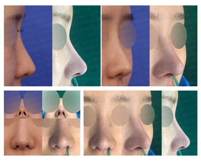 Before and after closed rhinoplasty showing correction of long nose, nostril asymmetry and tip redesign at Noselab Plastic Surgery Seoul Korea