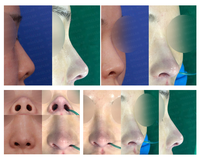Before and after closed rhinoplasty for upturned and bulbous nose correction at Noselab Plastic Surgery Clinic