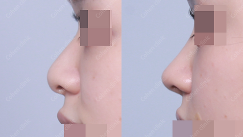 Closed rhinoplasty + bulbous nose + droopy nose + flat nose + alar