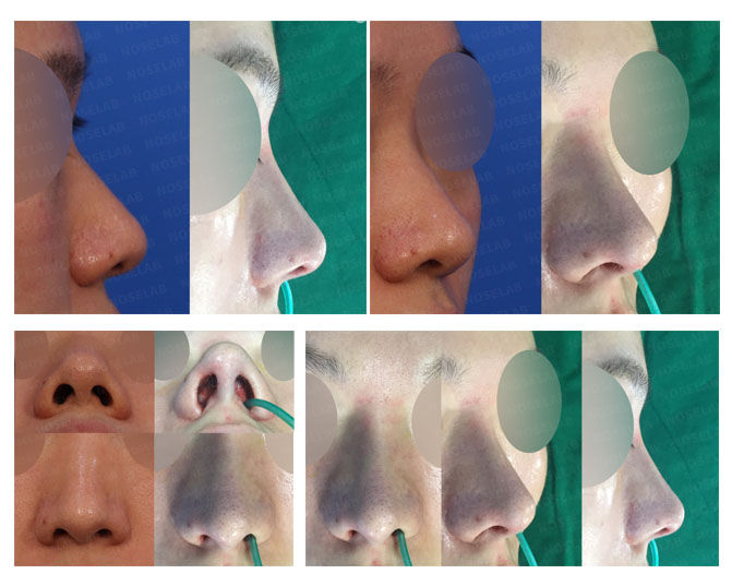 Before and after photo of Closed Rhinoplasty Korea correcting deviated nose with alar base reduction and nostril symmetry.