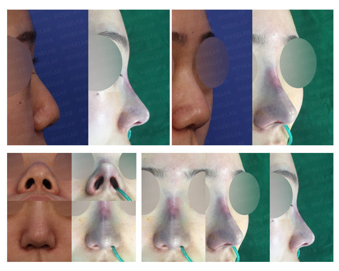 Before and after closed rhinoplasty Seoul for bulbous and hump nose correction with columella lengthening – showing refined nasal tip and smoother bridge line.