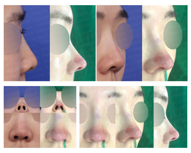 Upturned Nose Correction – Closed Rhinoplasty Case Study | Noselab Plastic Surgery Before and after closed rhinoplasty for upturned nose correction with columella lengthening and glabella line design at Noselab Plastic Surgery Korea