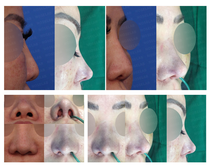 Rib Cartilage Rhinoplasty Before and After - Noselab Plastic Surgery