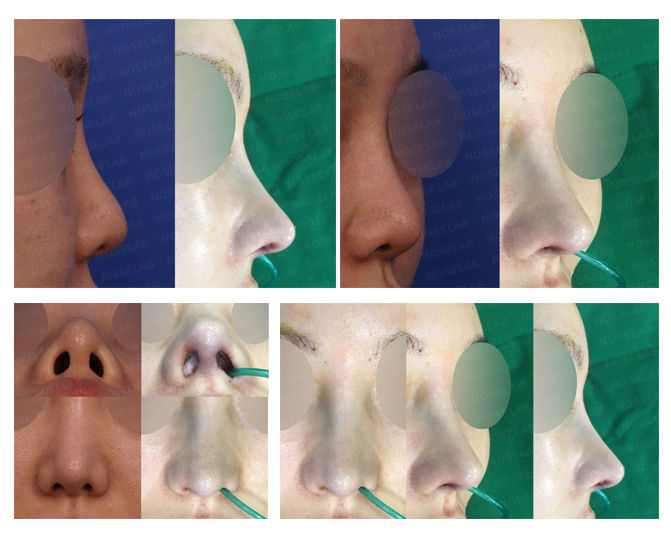 Before and after closed rhinoplasty showing droopy nose correction, bulbous tip refinement, and nostril asymmetry improvement with a natural, balanced nasal contour.
