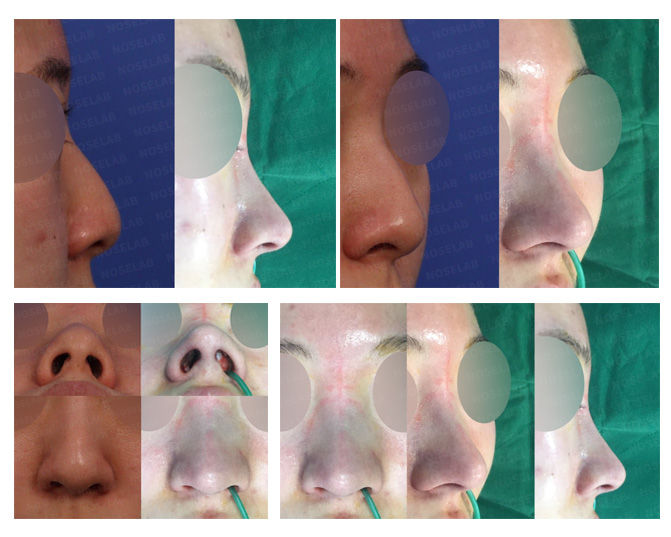 Before and after no-implant closed rhinoplasty in Seoul correcting hump nose, hanging tip, bulbous tip, and nostril asymmetry using autologous cartilage only — natural contour achieved without external incision or silicone implant.