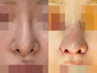Closed rhinoplasty + Revision + Donated rib cartilage + silicone removal + alloderm + Lowering starting point + angle correction + alarplasty(revision/outside) + alar rim graft + long nose 
