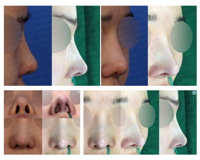 Pre-operative and Post-operative Front View of Deviated and Upturned Nose Correction