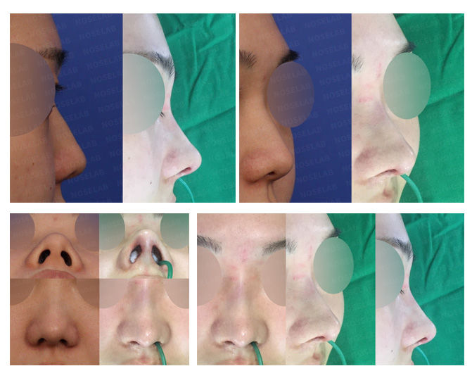 Before and after closed rhinoplasty Seoul for hump nose, tip raising, and columella lengthening – showing refined nasal bridge, balanced nostrils, and natural tip projection.