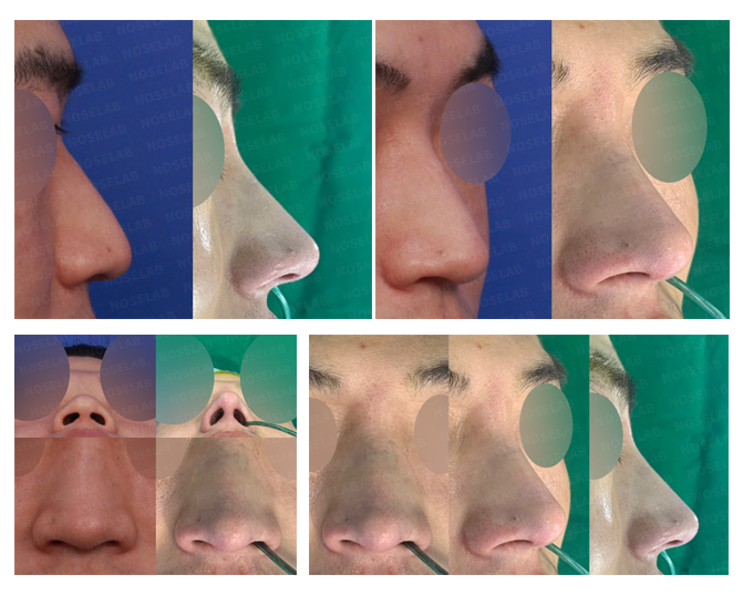Before and after closed rhinoplasty result showing correction of hanging nose, long nose, and columella at Noselab Plastic Surgery Seoul, performed by Dr. Chayoung Kang