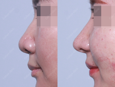 Closed rhinoplasty + revision + donated rib cartilage + non implant(bridge) + alarplasty + alar lift + bulbous nose correction + hump reduction + osteotomy + septoplasty