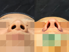 Closed rhinoplasty + revision + tip plasty(rib cartilage) + silicone + osteotomy + revision alar plasty(outside) + columella redesign + bulbous nose correction