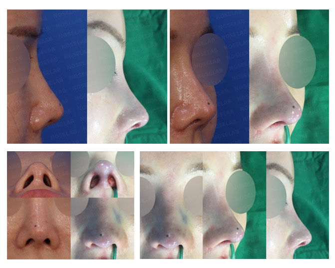 revision closed rhinoplasty korea before and after collage showing correction of upturned nose, deviated bridge, and nostril asymmetry through closed approach and nasal lengthening