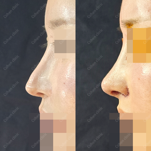 Closed rhinoplasty(revision) + rib cartilage + alloderm + osteotomy + alarplasty + alar base reconstruction + deviated nose correction + droopy nose correction + arrow nose correction
