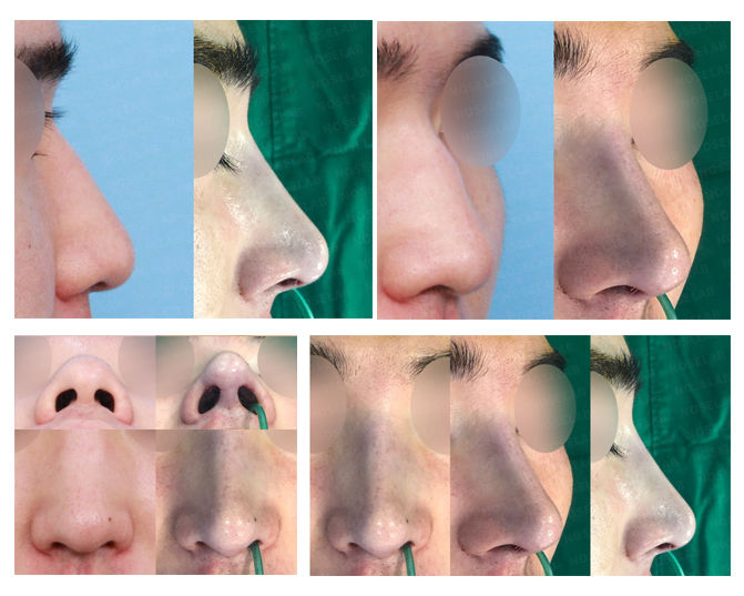 Photograph from the archive: hump nose osteotomy , hanging nose tip , bulbous nose (closed rhinoplasty) (image 1)