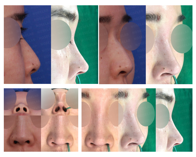 Closed Rhinoplasty Result – Hump Correction and Tip Refinement | Noselab Plastic Surgery Before and after closed rhinoplasty showing dorsal hump removal, thread removal, and nasal tip refinement at Noselab Plastic Surgery Seoul Korea