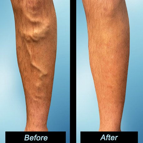 Minimally Invasive Varicose Vein Treatments: A Complete Patient Guide