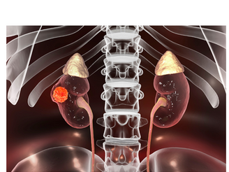 BÖBREK KANSERİ | TANISI VE TEDAVİSİ