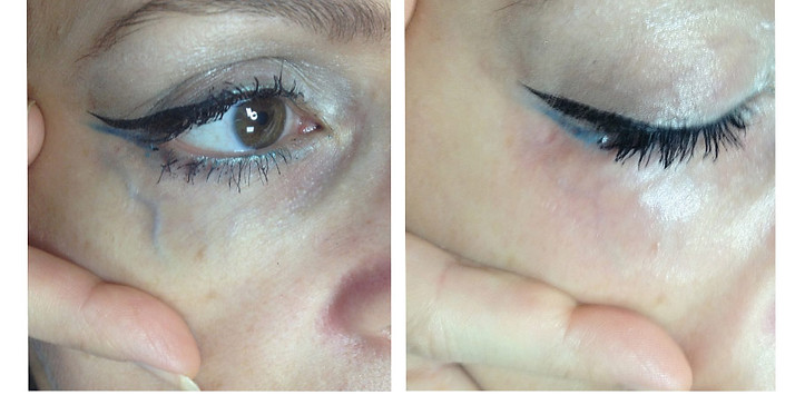 clearV-under-eyes-before-after-2.jpg